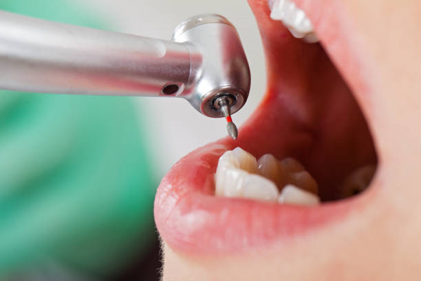 Best Emergency Tooth Extraction in Brownsville, KY